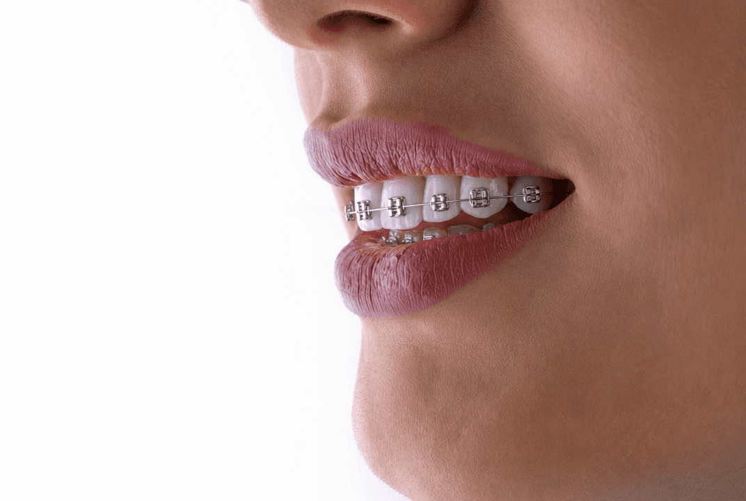 Smile with AI-added braces